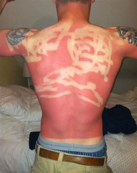 why is it a sunburn gets worse after dark.